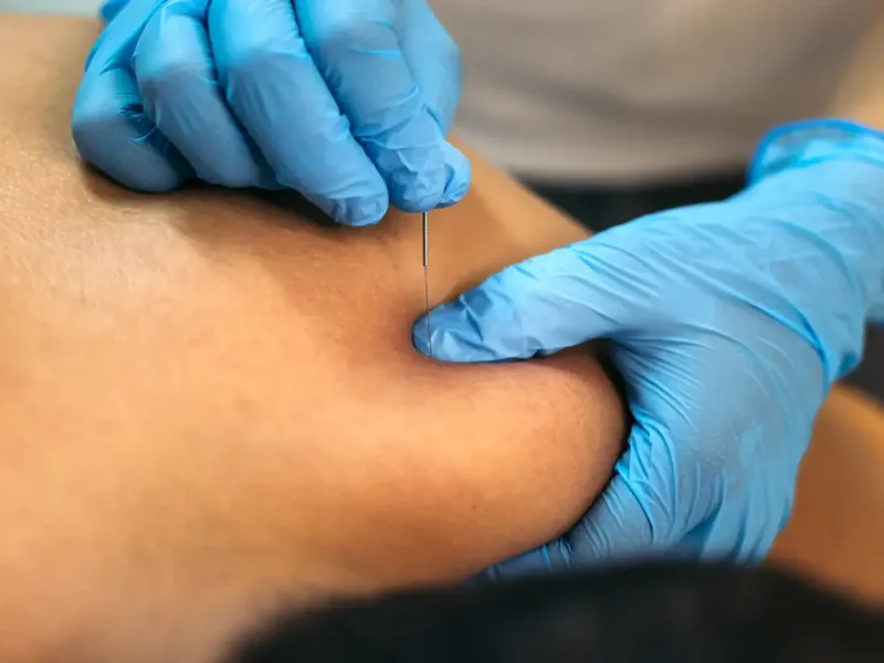 Doctor of Physical Therapy performing dry needling on a patient's shoulder